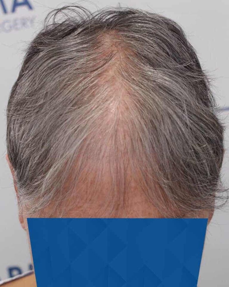 Results Before & After Gallery - Patient 362767 - Image 3