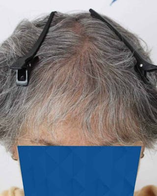 Results Before & After Gallery - Patient 362767 - Image 4