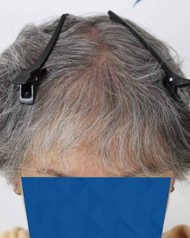 Results Before & After Gallery - Patient 362767 - Image 4