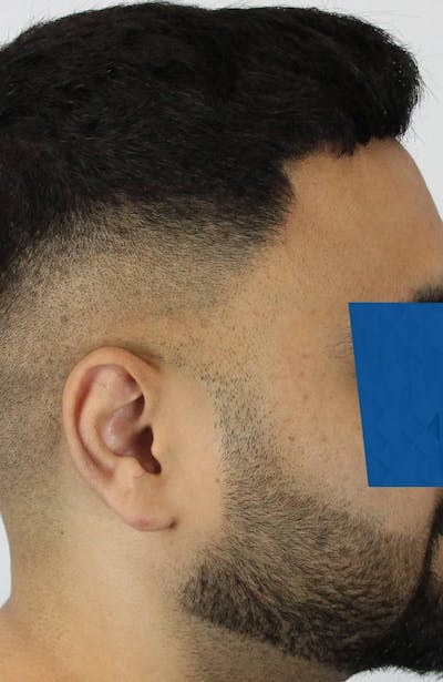 Results Before & After Gallery - Patient 271860 - Image 1