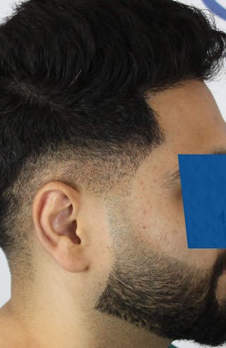 Results Before & After Gallery - Patient 271860 - Image 2