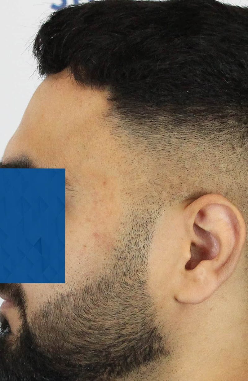 Results Before & After Gallery - Patient 271860 - Image 3