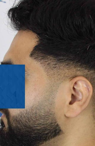 Results Before & After Gallery - Patient 271860 - Image 4