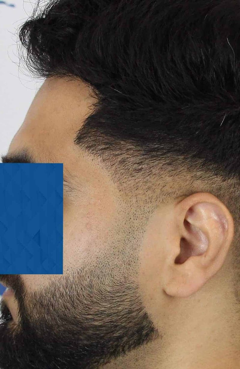 Results Before & After Gallery - Patient 271860 - Image 4