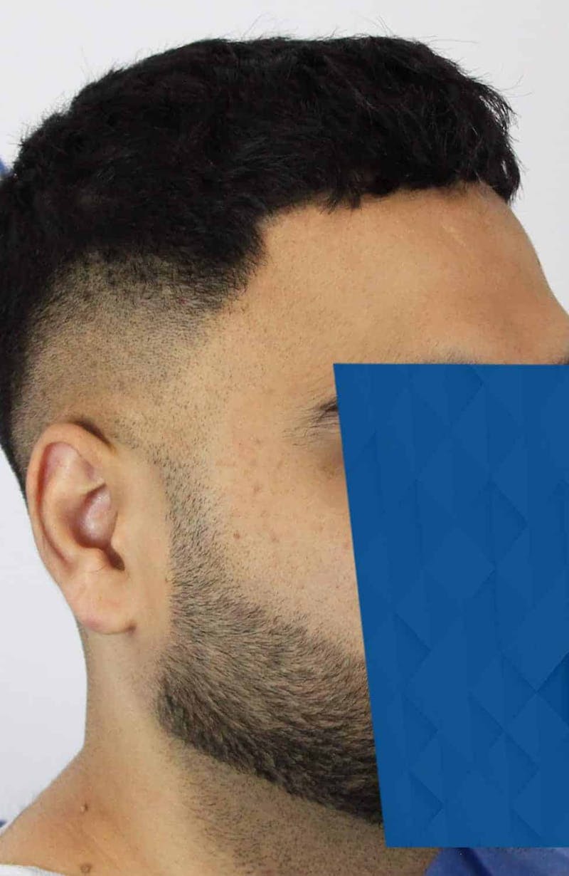 Results Before & After Gallery - Patient 271860 - Image 5