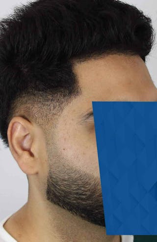 Results Before & After Gallery - Patient 271860 - Image 6