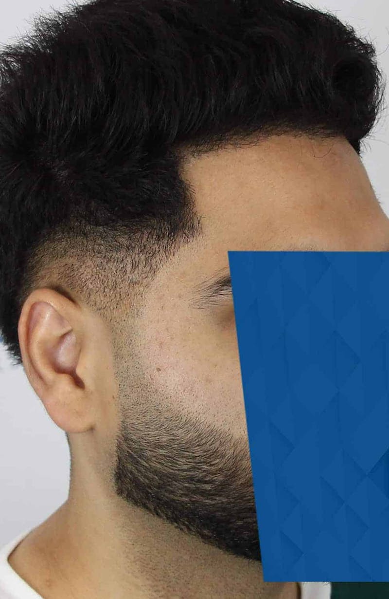 Results Before & After Gallery - Patient 271860 - Image 6