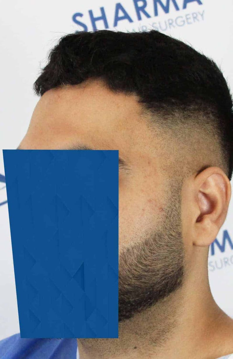 Results Before & After Gallery - Patient 271860 - Image 7