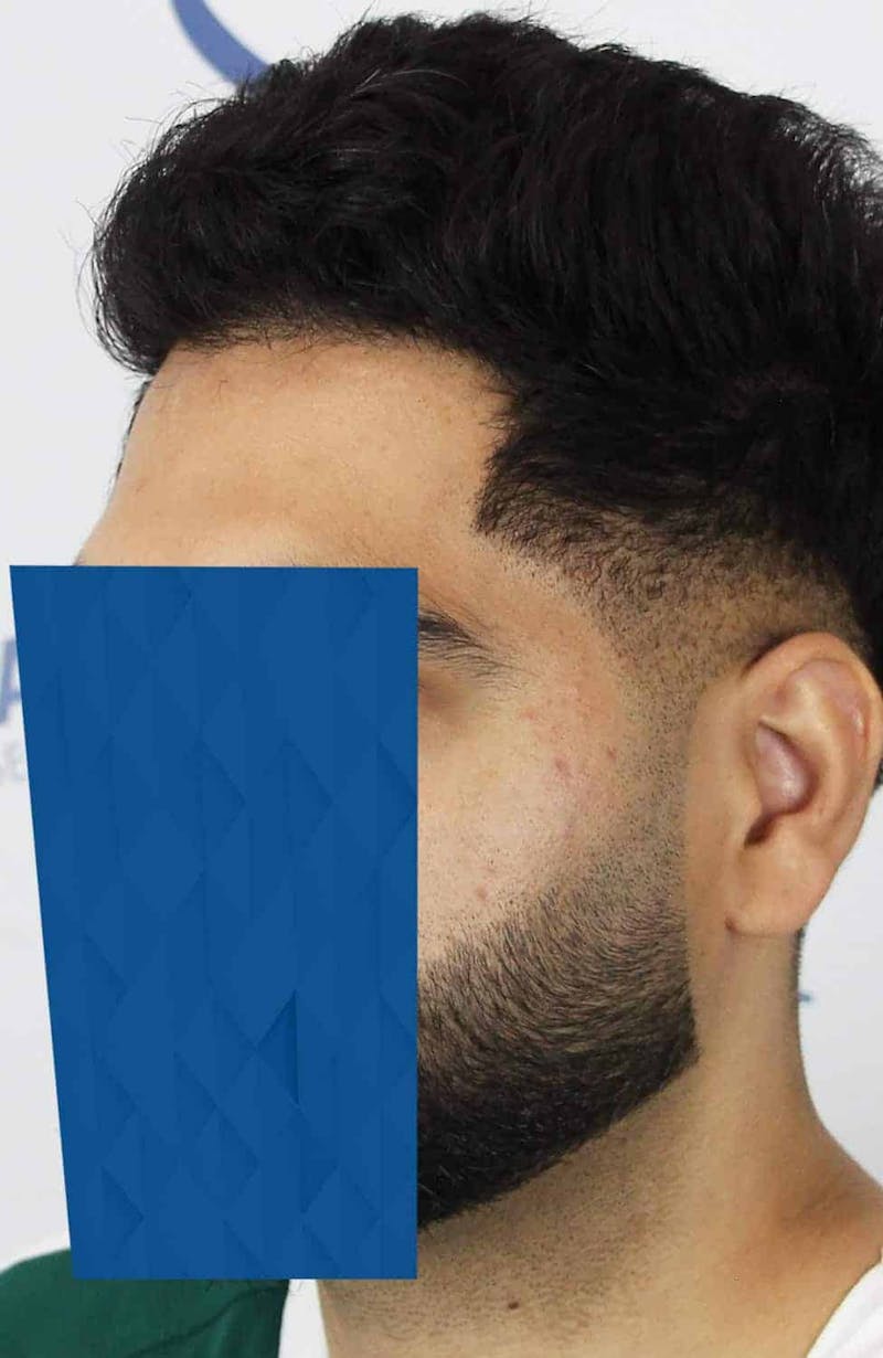 Results Before & After Gallery - Patient 271860 - Image 8