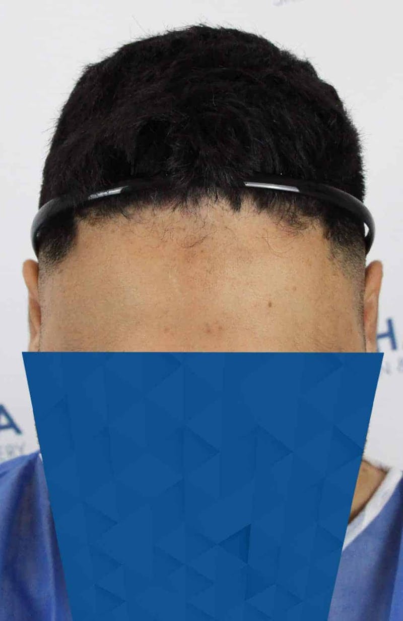 Results Before & After Gallery - Patient 271860 - Image 9