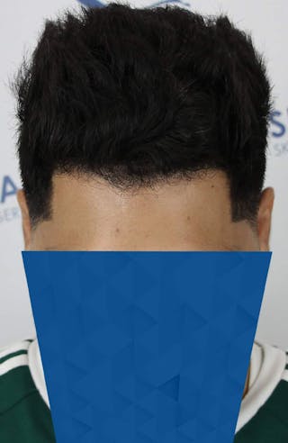 Results Before & After Gallery - Patient 271860 - Image 10