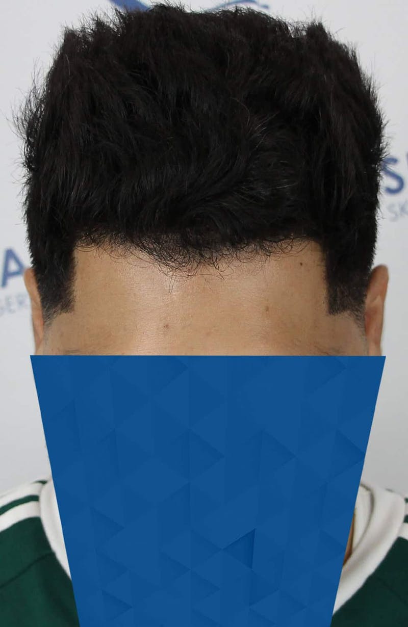 Results Before & After Gallery - Patient 271860 - Image 10