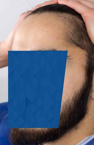 Results Before & After Gallery - Patient 260703 - Image 1