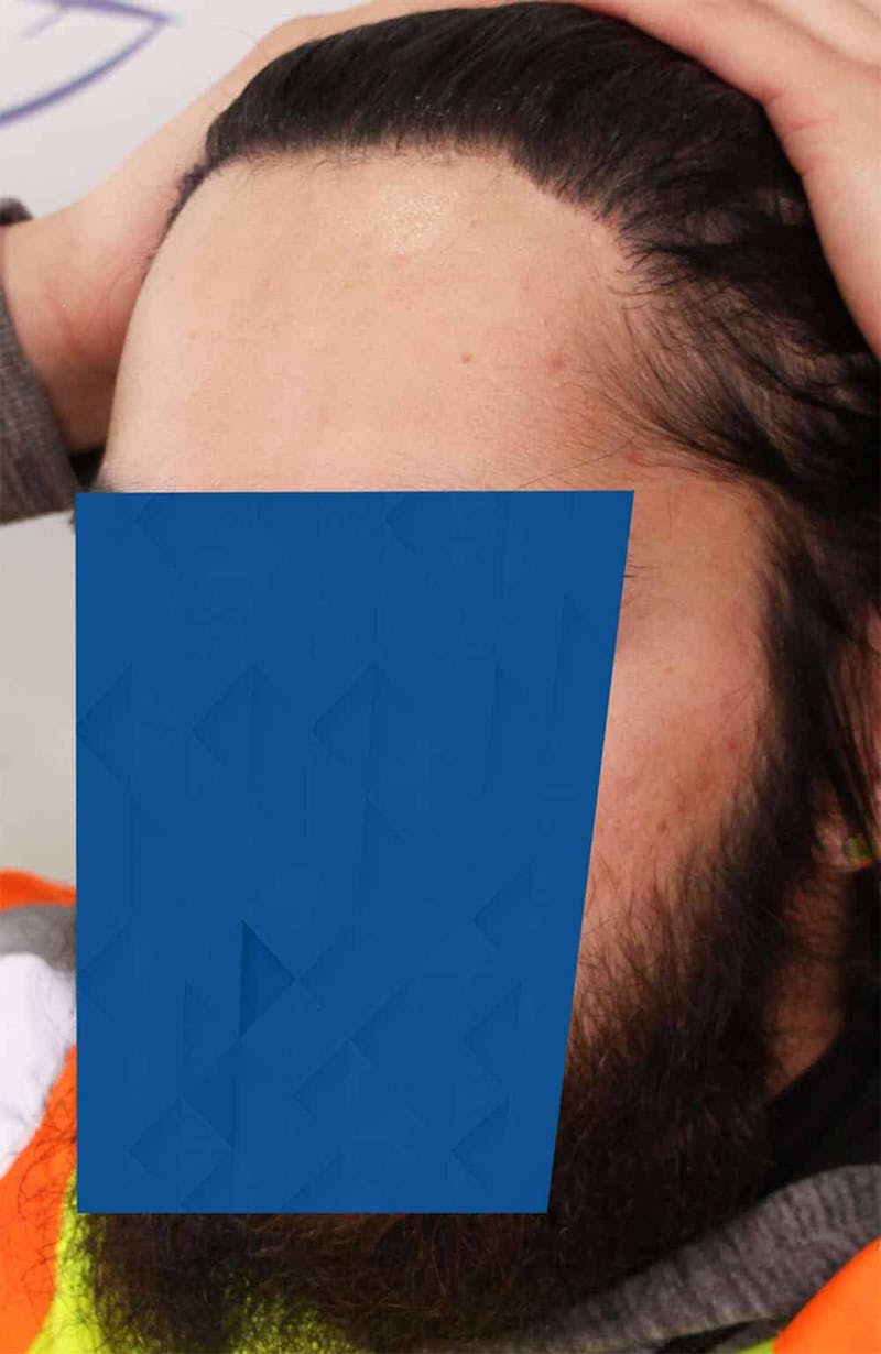 Results Before & After Gallery - Patient 260703 - Image 2