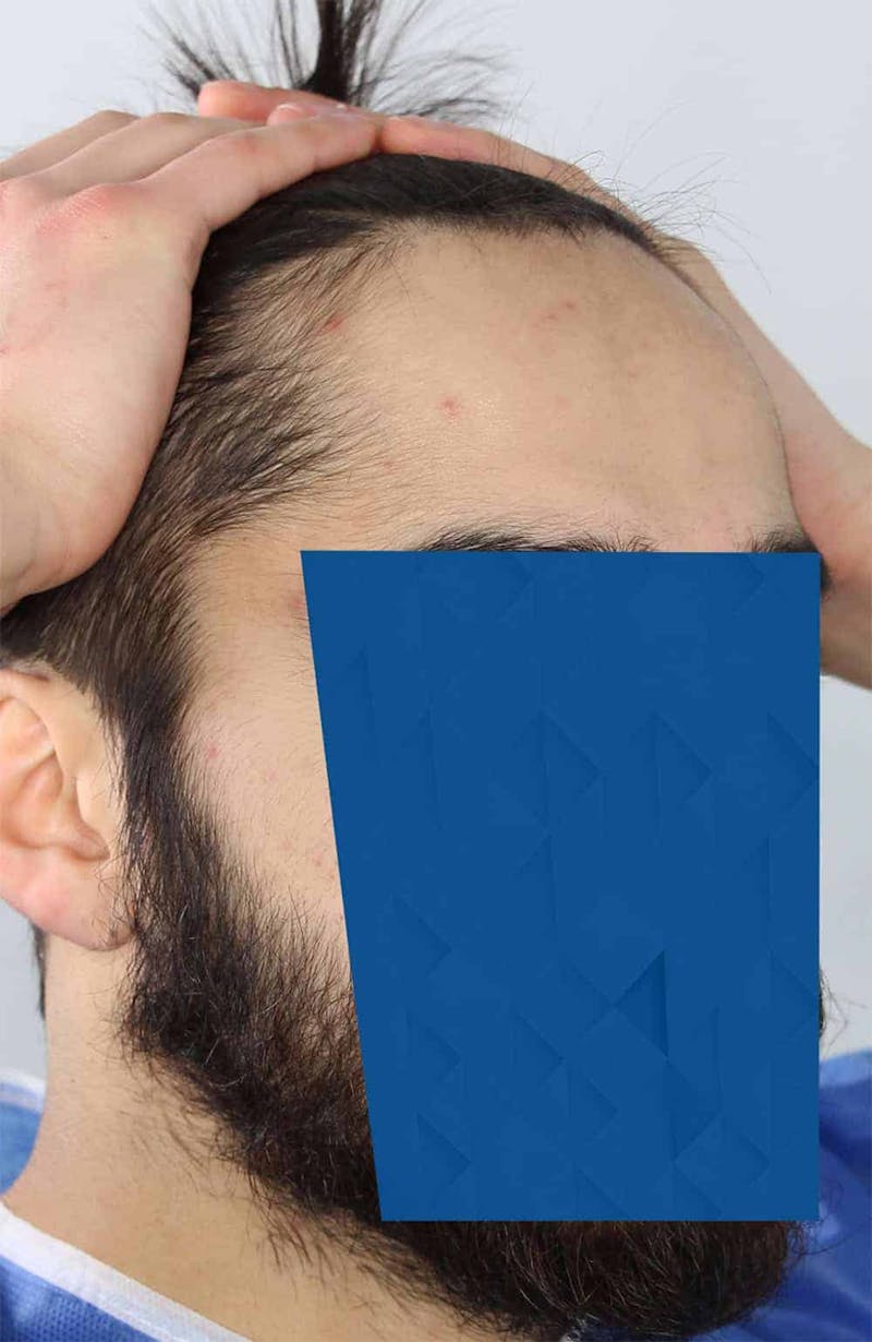 Results Before & After Gallery - Patient 260703 - Image 3