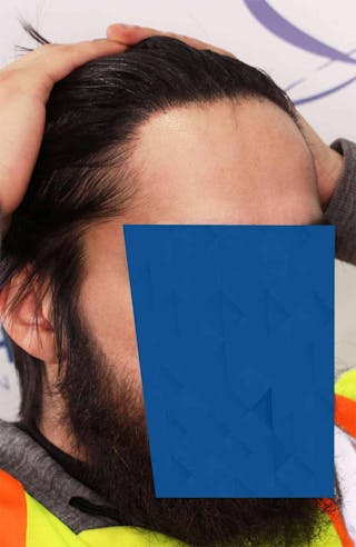 Results Before & After Gallery - Patient 260703 - Image 4