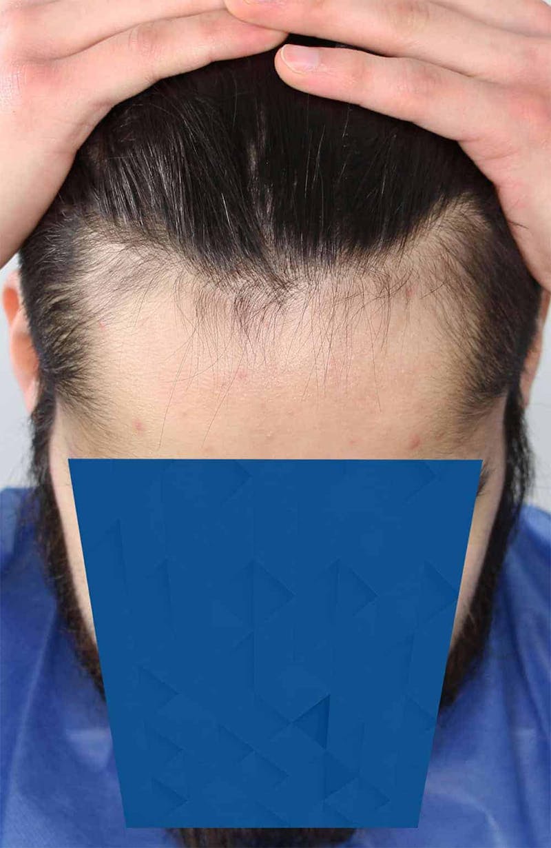 Results Before & After Gallery - Patient 260703 - Image 5