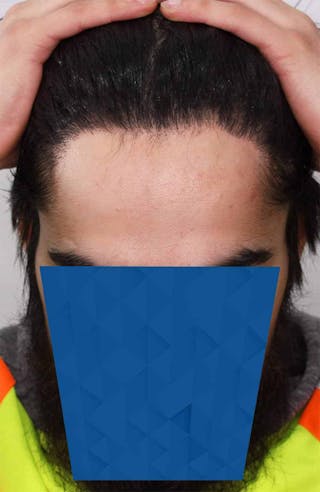 Results Before & After Gallery - Patient 260703 - Image 6