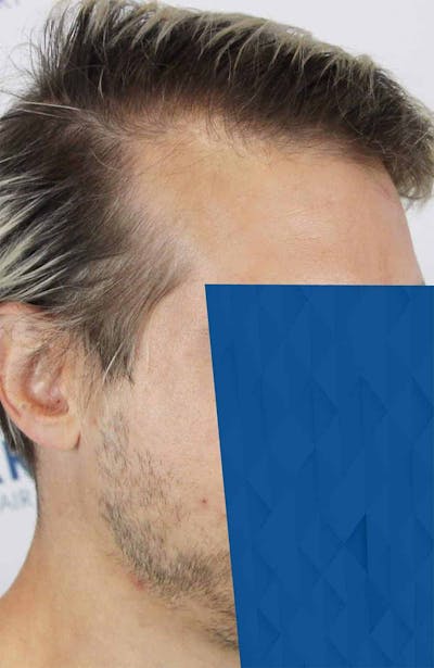 Results Before & After Gallery - Patient 318355 - Image 1