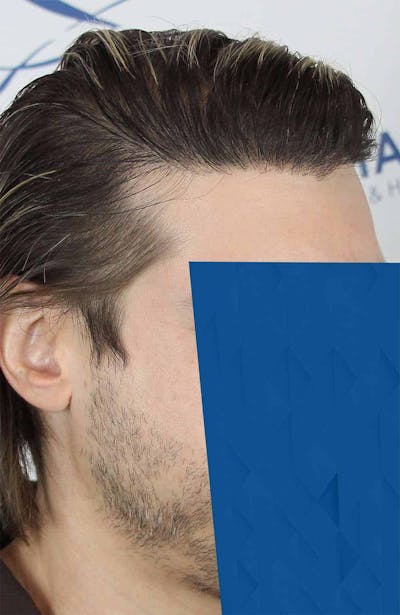 Results Before & After Gallery - Patient 318355 - Image 2