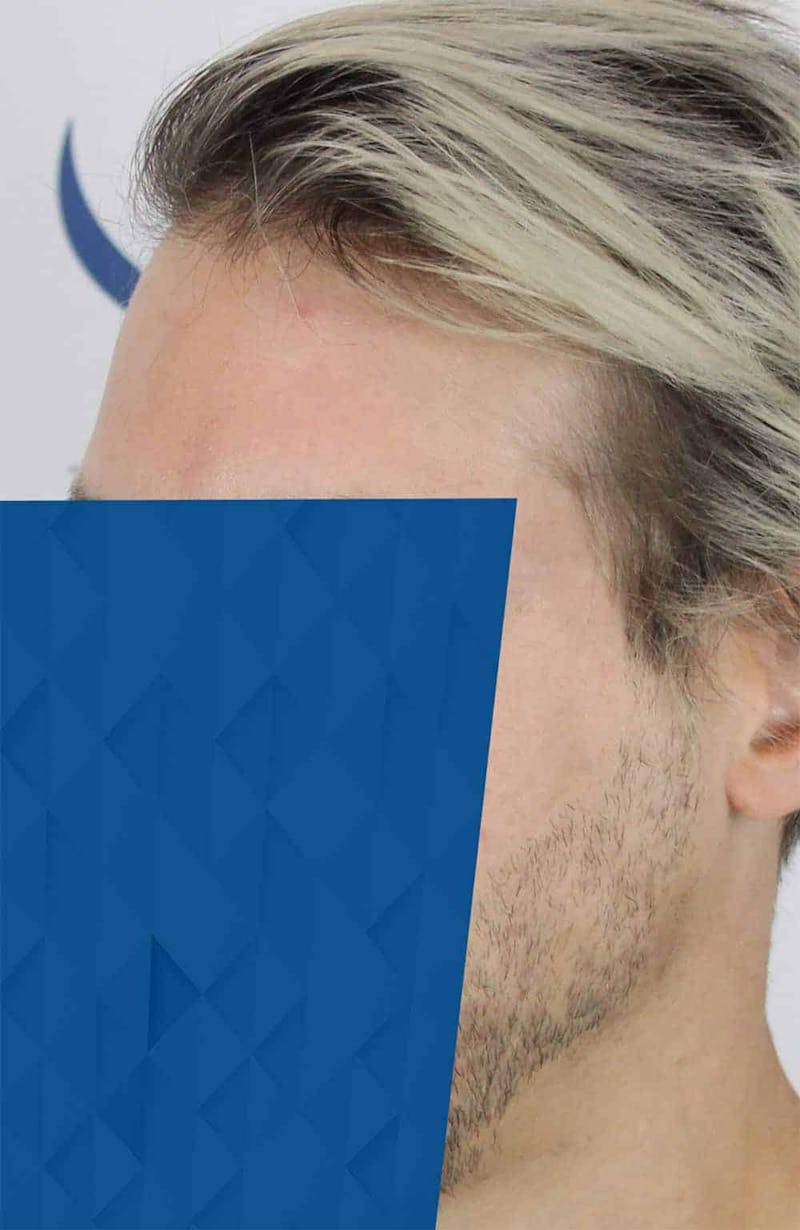 Results Before & After Gallery - Patient 318355 - Image 3