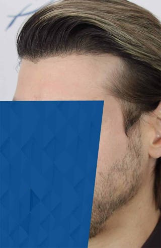 Results Before & After Gallery - Patient 318355 - Image 4