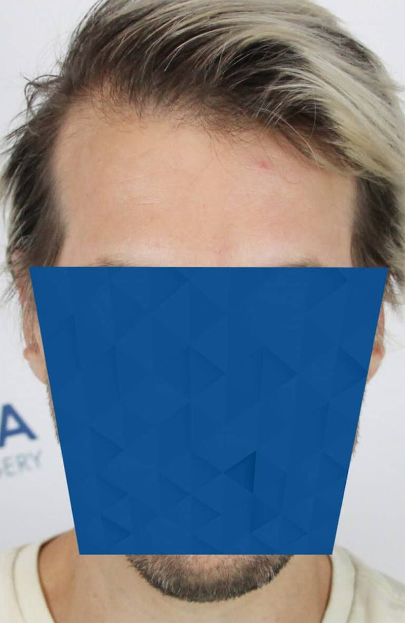 Results Before & After Gallery - Patient 318355 - Image 5