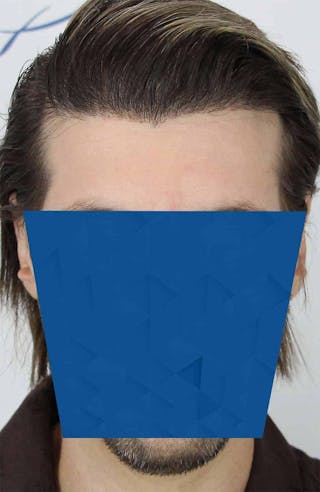 Results Before & After Gallery - Patient 318355 - Image 6