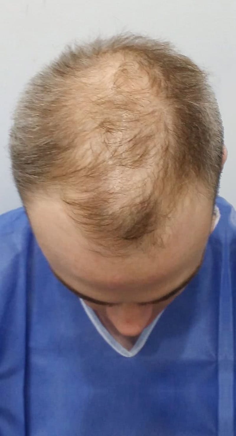 Results Before & After Gallery - Patient 229144 - Image 1