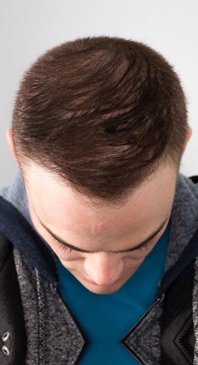 Results Before & After Gallery - Patient 229144 - Image 2