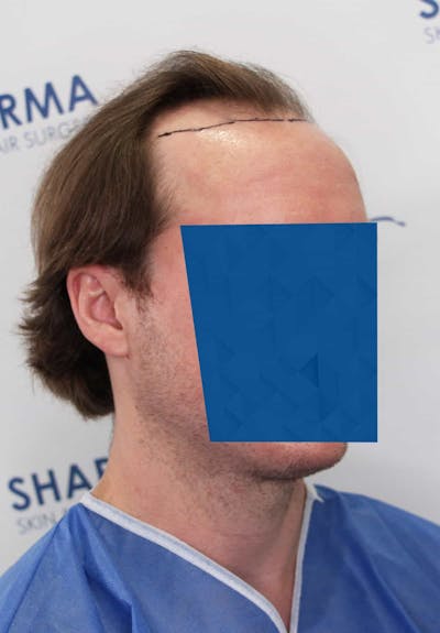 Results Before & After Gallery - Patient 339150 - Image 1