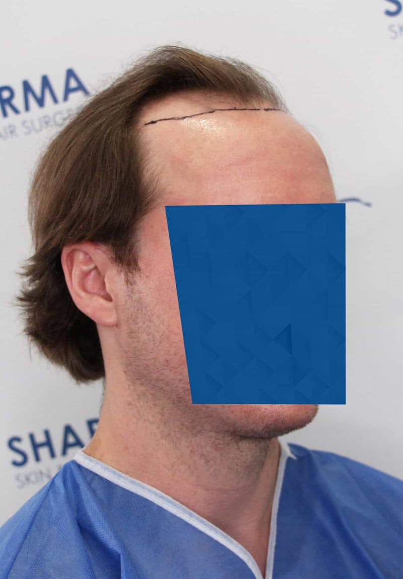 Results Before & After Gallery - Patient 339150 - Image 1