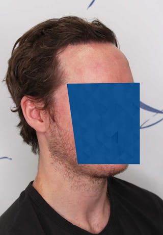 Results Before & After Gallery - Patient 339150 - Image 2