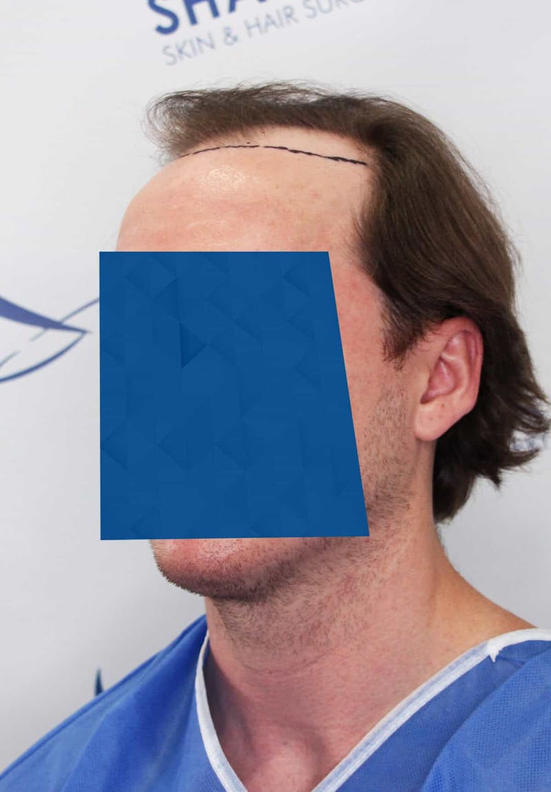 Results Before & After Gallery - Patient 339150 - Image 3