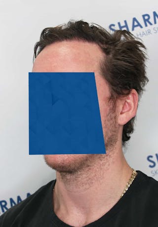 Results Before & After Gallery - Patient 339150 - Image 4