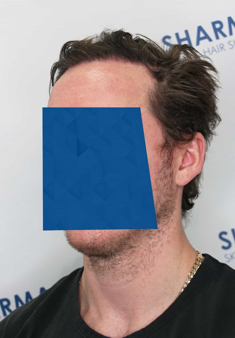 Results Before & After Gallery - Patient 339150 - Image 4