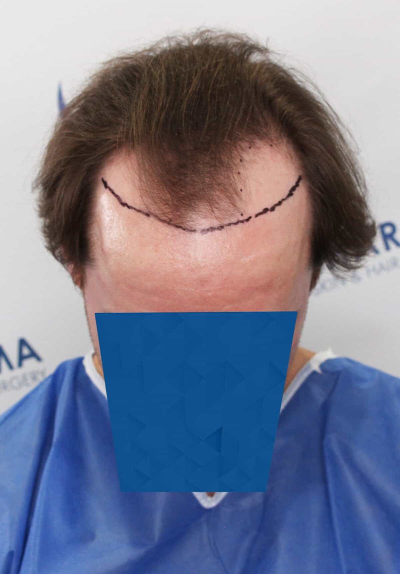 Results Before & After Gallery - Patient 339150 - Image 5