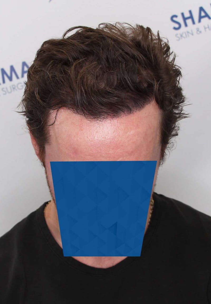 Results Before & After Gallery - Patient 339150 - Image 6