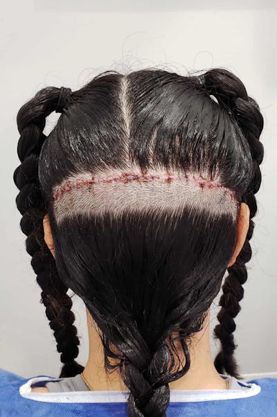 Results Before & After Gallery - Patient 115965 - Image 1