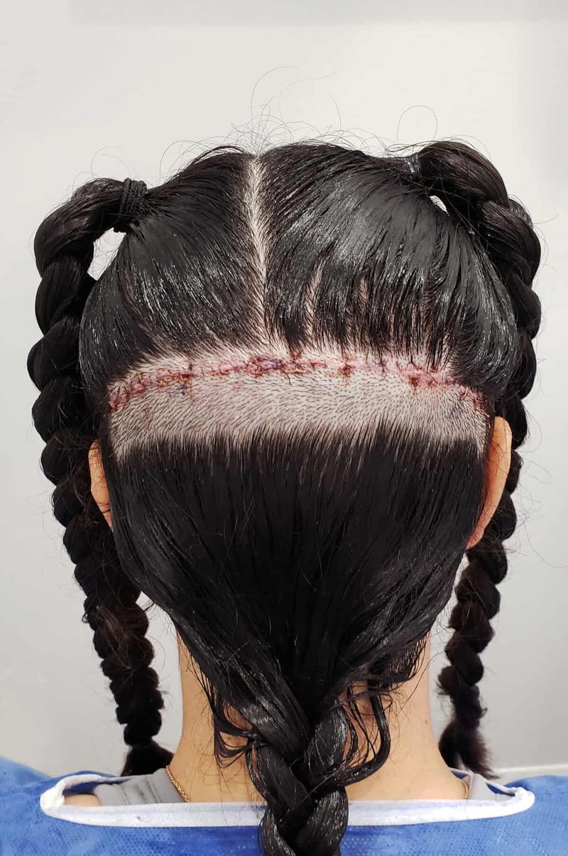 Results Before & After Gallery - Patient 115965 - Image 1