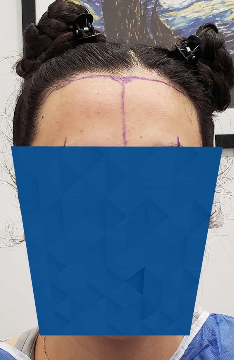Results Before & After Gallery - Patient 115965 - Image 3