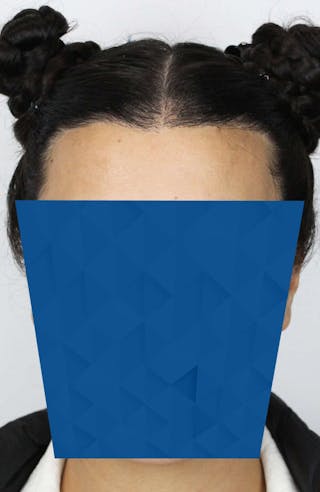 Results Before & After Gallery - Patient 115965 - Image 4