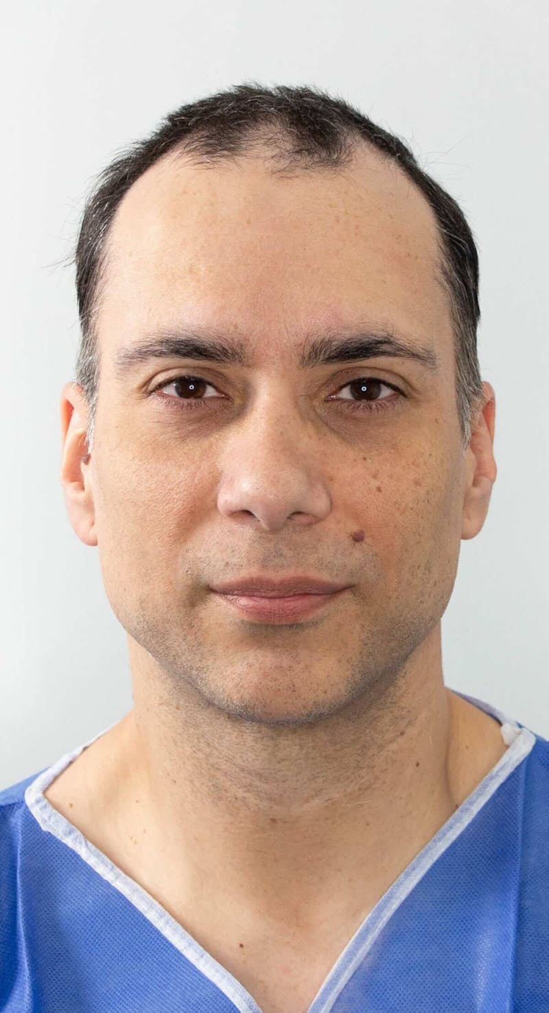 Results Before & After Gallery - Patient 298328 - Image 1