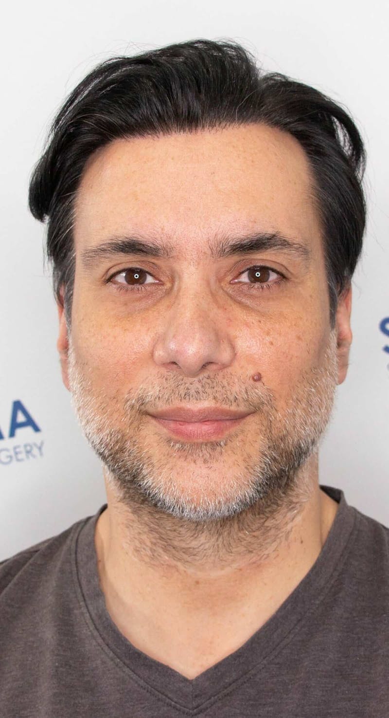Results Before & After Gallery - Patient 298328 - Image 2
