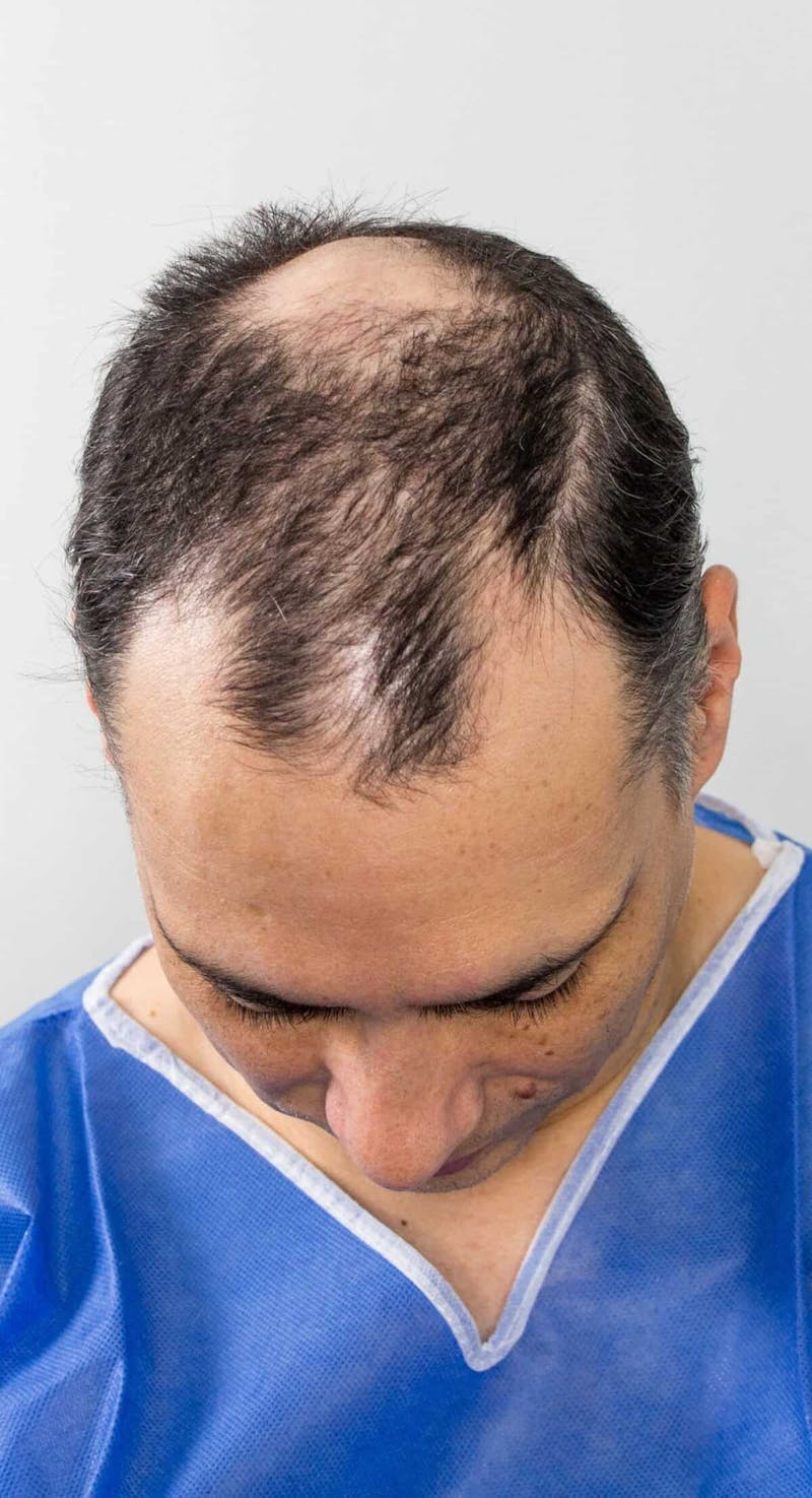 Results Before & After Gallery - Patient 298328 - Image 3