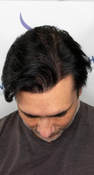 Results Before & After Gallery - Patient 298328 - Image 4
