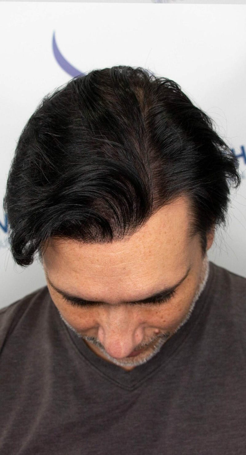 Results Before & After Gallery - Patient 298328 - Image 4