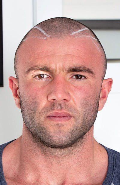 Results Before & After Gallery - Patient 111404 - Image 1