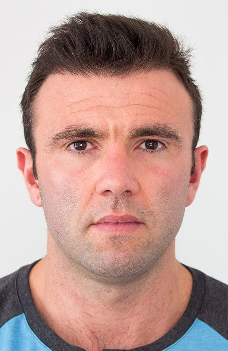 Results Before & After Gallery - Patient 111404 - Image 2