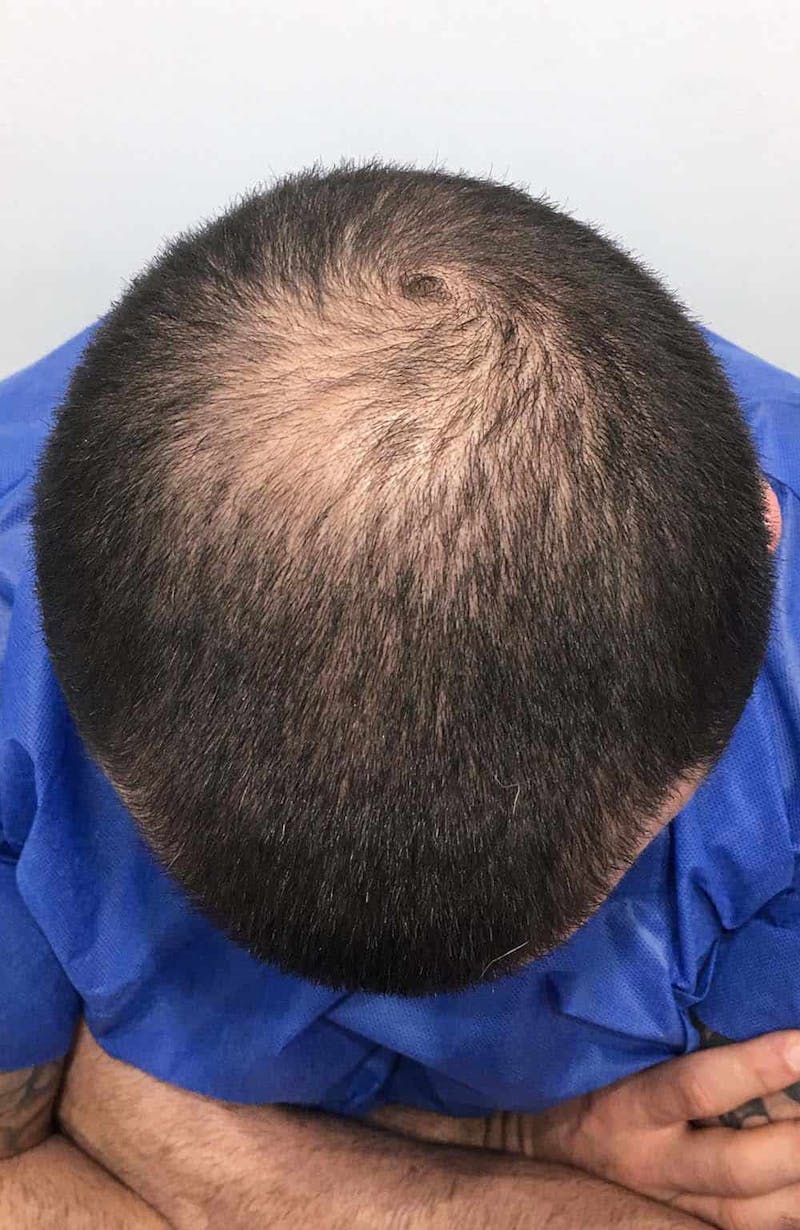 Results Before & After Gallery - Patient 111404 - Image 3